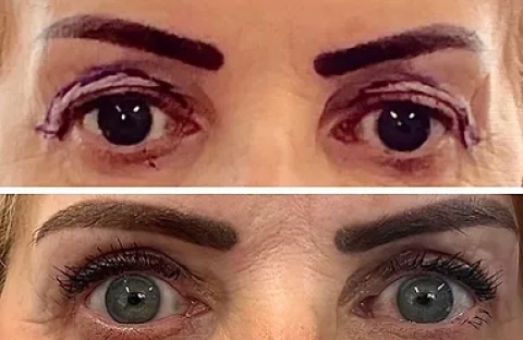 Eyelid Surgery (Blepharoplasty) - Results